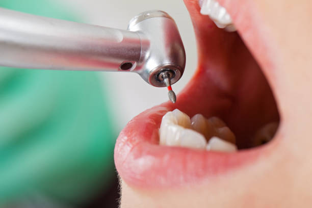 Best Emergency Wisdom Tooth Extraction in Loris, SC